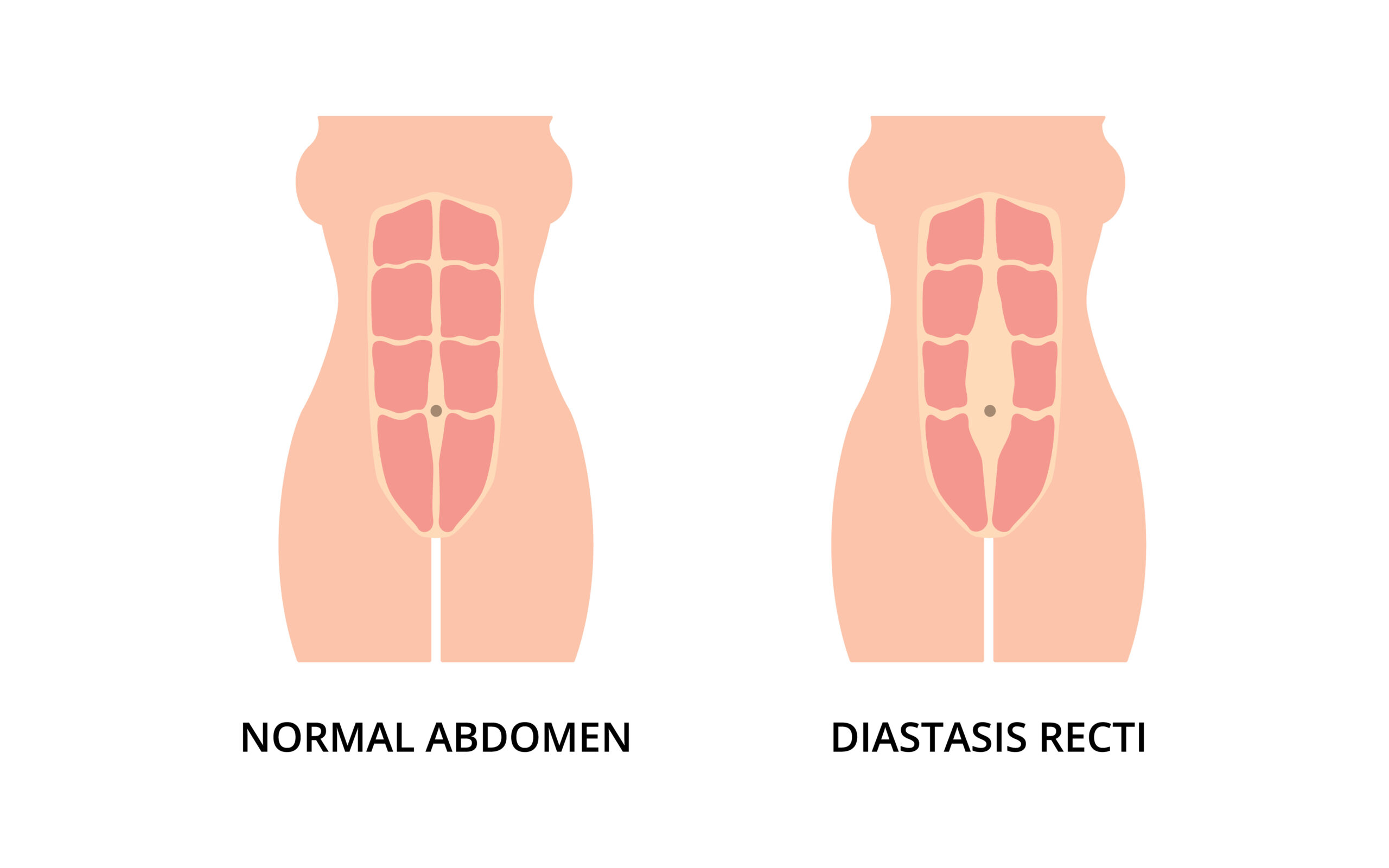 Exercises-for-diastasis-recti