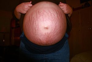 Stretch-Marks-Pregnancy